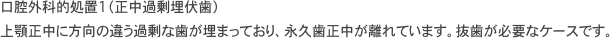 インプラント治療