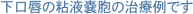インプラント治療