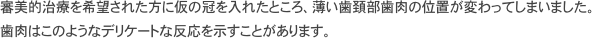インプラント治療