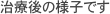 歯内療法